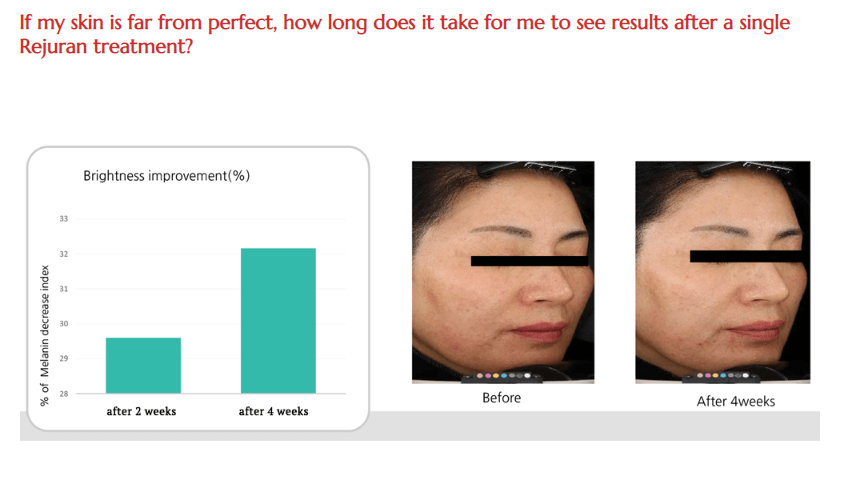 Rejuran HB - FDA Approved Skin Boosters